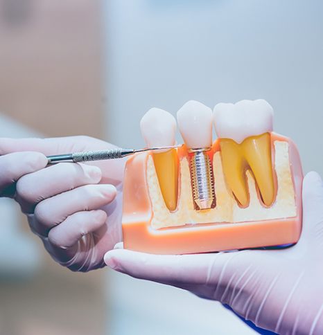 Dentist pointing to dental implant model