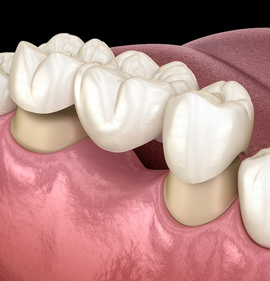 Render of a dental bridge in Denison, IA being placed on natural teeth