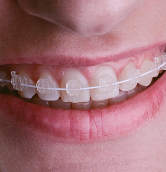 close-up of smile with clear braces on teeth