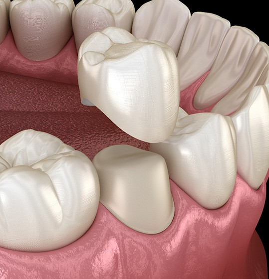 Render of dental crown in Denison, IA being placed on tooth