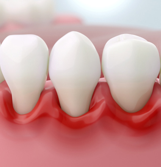 Illustration of red, inflamed gums
