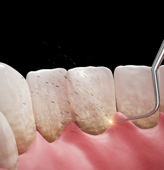 Illustration of dental tool cleaning patient's teeth