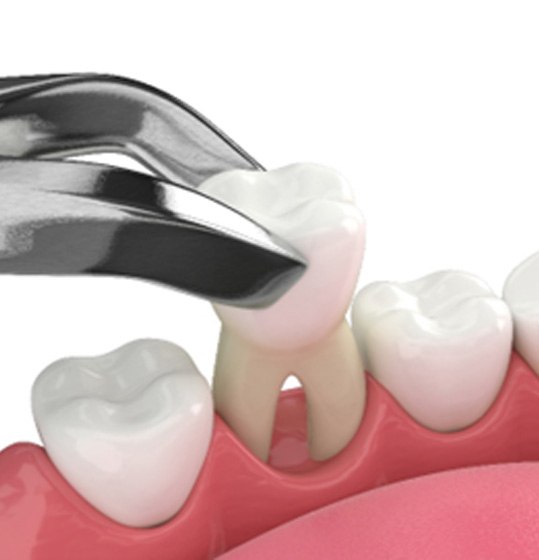Illustration of tooth being removed with special dental tool