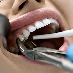 A dentist extracting a patient’s tooth