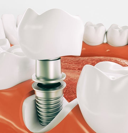 Animated dental implant placement procedure
