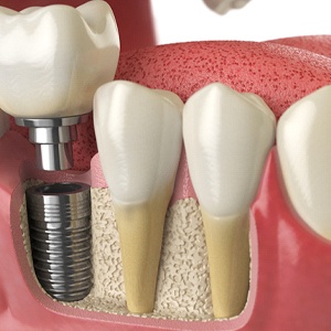 computer illustration of an implant-retained dental crown