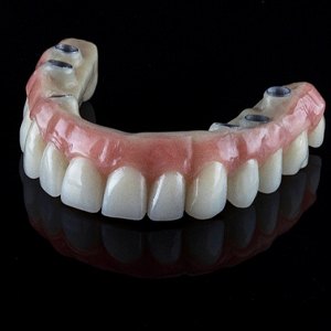 implant-retained denture