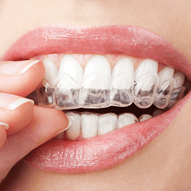 A woman straightening her teeth with Invisalign in Denison putting in an aligner