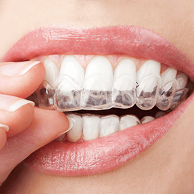 A woman straightening her teeth with Invisalign in Denison putting in an aligner 