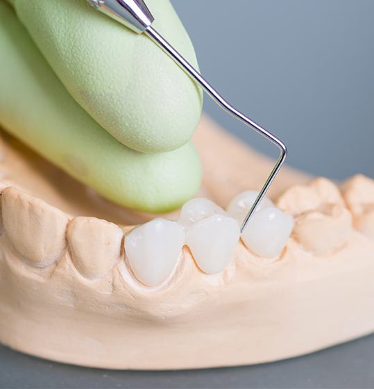 Model smile with dental bridge restoration