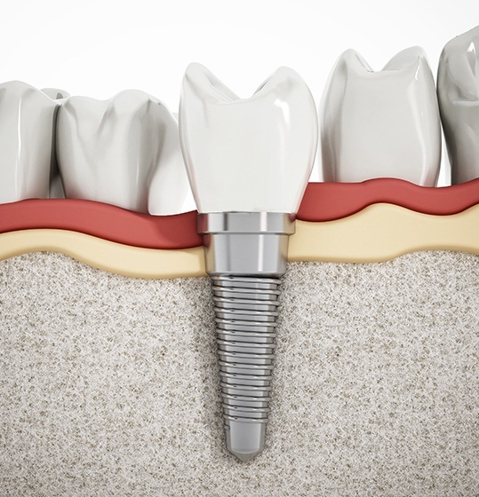 Animated dental implant supported dental crown