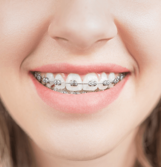 Smile with traditional braces