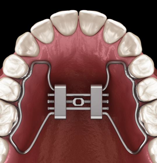 Animated smile with palatal expanders