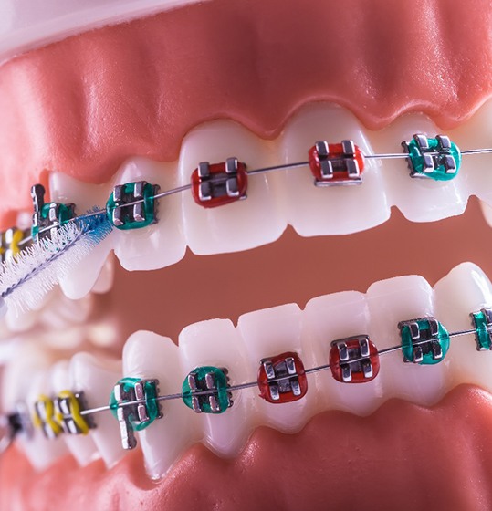 model braces being cleaned demonstrating preventing orthodontic emergencies in Denison
