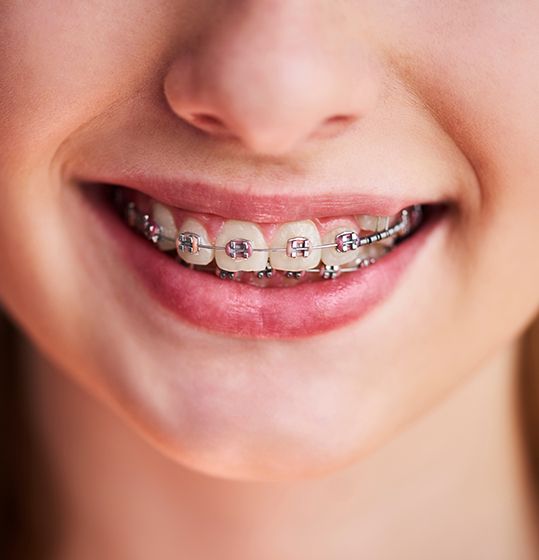 Closeup of a girl’s braces
