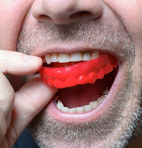 Man placing an athletic mouthguard