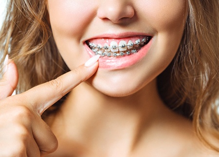 close-up of smile with traditional braces in Denison