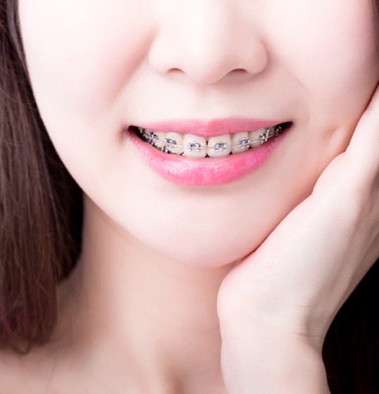 woman in pink t-shirt smiling to show her braces