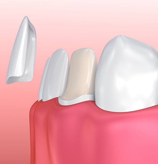 diagram of porcelain veneer being placed on tooth