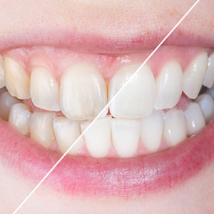 Up-close view of stained and brighter teeth