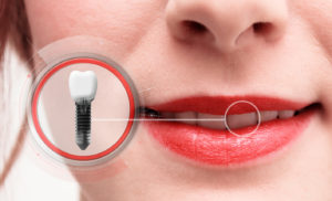 Dental implant in Denison zoomed in perspective 