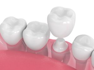 dental crown being placed over a tooth
