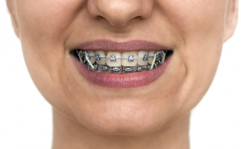 Using Rubber bans with Braces