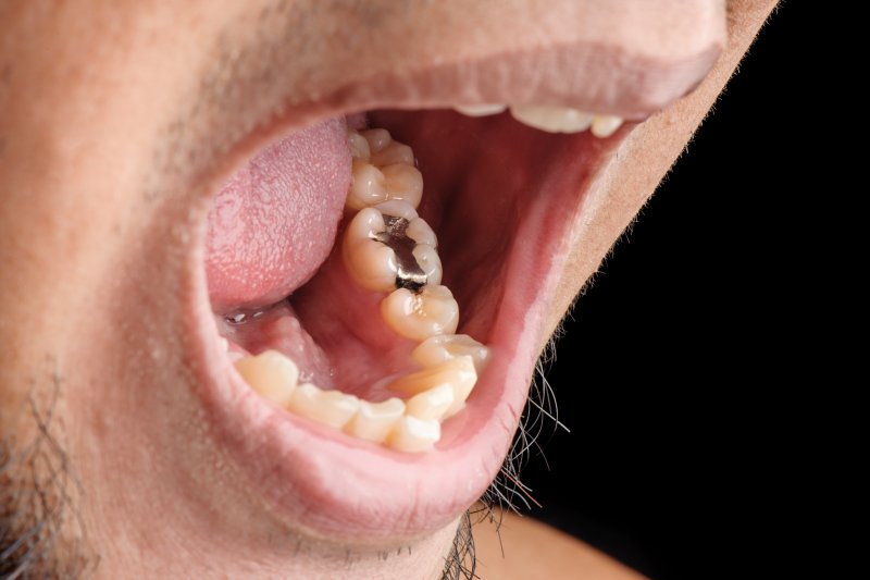 A man with amalgam fillings