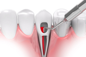 Illustration of a root canal treatment being performed